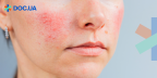Купероз: когда коже лица нужна помощь?